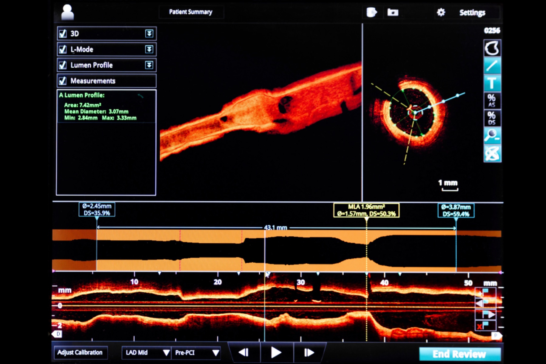 Imagen intravascular OCT
