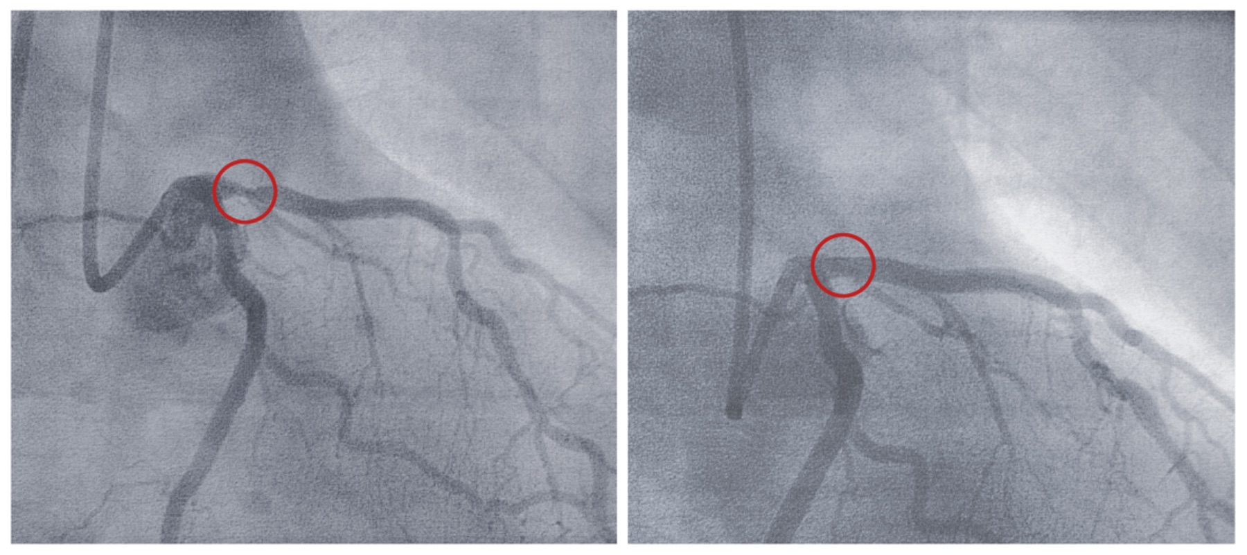 Intervención endovascular antes/después