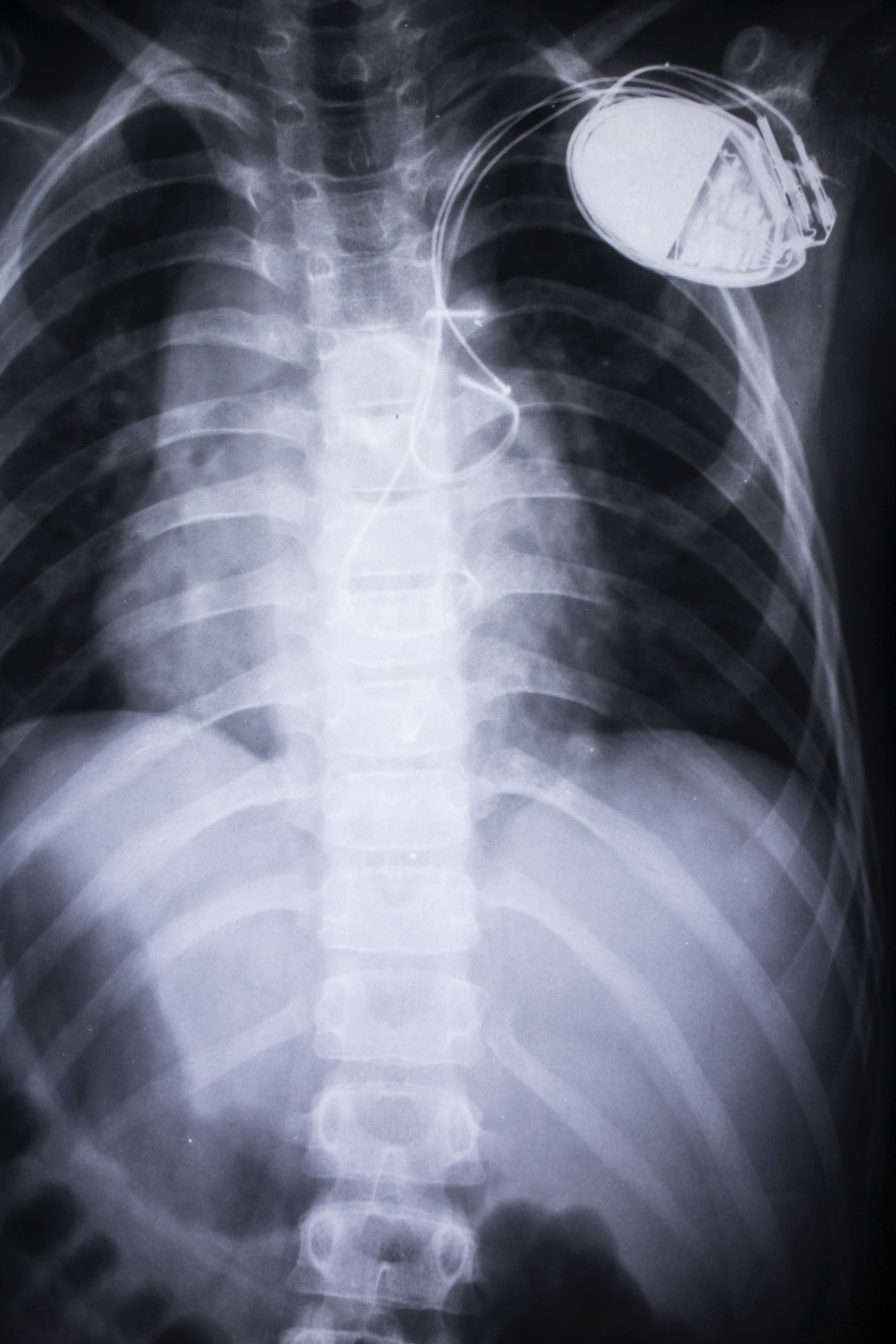 Marcapasos en radiografía